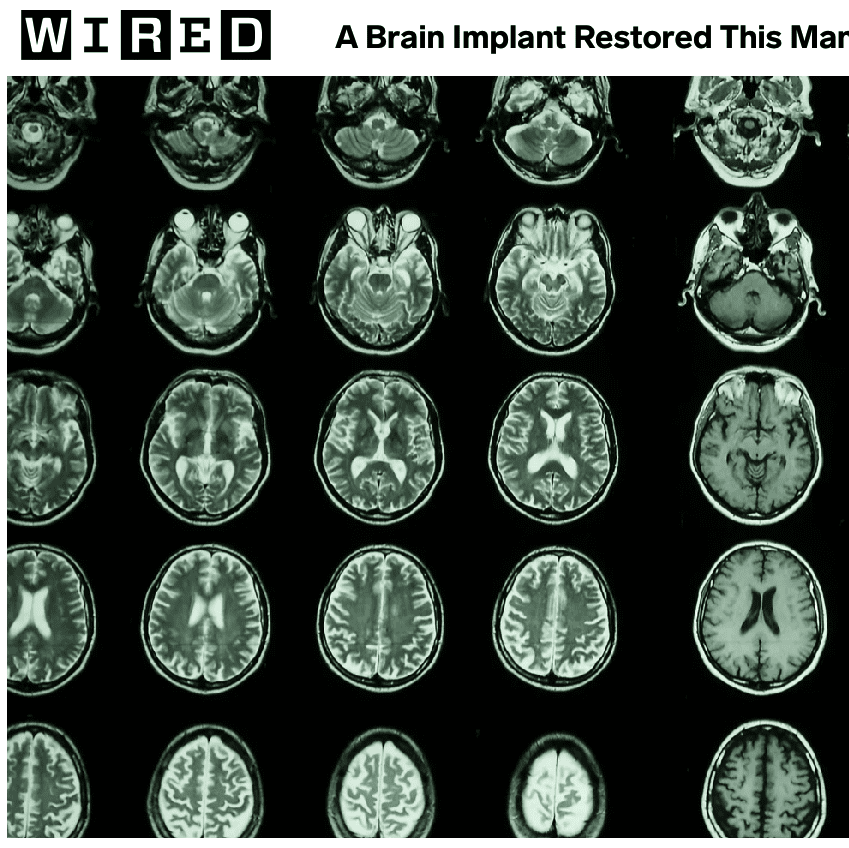 A Brain Implant Restored This Man's Motion and Sense of Touch